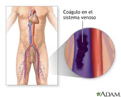 Acquired risk factors for thrombosis. Trombosis Venosa Serie Indicaciones Medlineplus Enciclopedia Medica