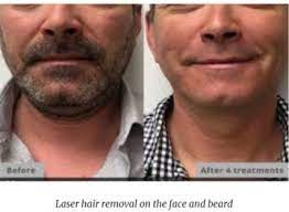 laser hair removal face men benefits