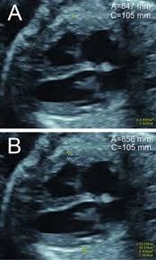 Fetal Heart Size Devore 2016 Journal Of Ultrasound In