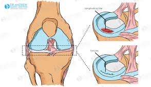 meniscus tear of the knee surgery