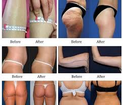 tulsa laser lipo treatments and laser