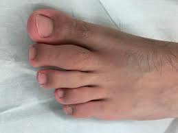 a painful swollen toe the bmj