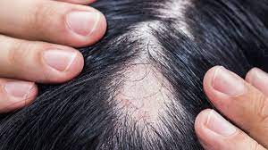what causes hair loss in women goodrx