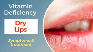 ouch my lip s vitamin deficiency s