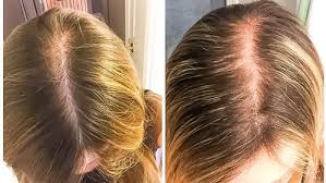 All you need is to get through this period that appears to be very difficult from the point of view of your hair. Solutions For Postpartum Hair Loss After Pregnancy First Thyme Mom