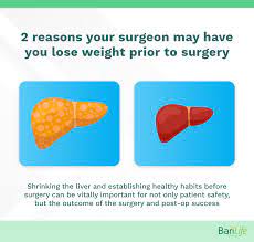 weigh to have gastric byp surgery