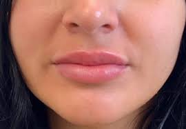 how long do lip fillers last how to