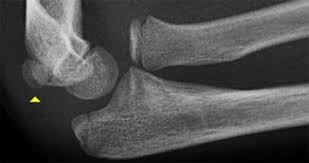 Incarcerated medial epicondyle fractures in association with elbow trauma are rare and an absolute indication for intervention. The Radiology Assistant Fractures In Children