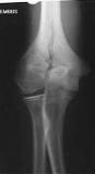 Image result for icd-10 code for supracondylar humerus fracture with intercondylar extension