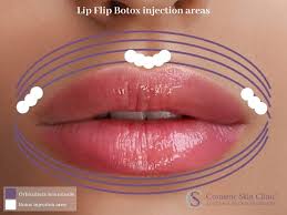 lip flip with botox