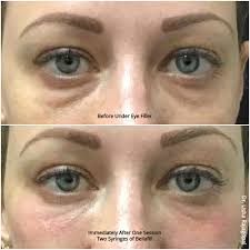 This beautiful client.@jessdykstra1 is thin making her undereye area also very dark and hollow appearing. Under Eye Filler Dark Circles Eye Bags Photos Usha Rajagopal Md