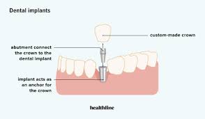 benefits of dental implants drawbacks