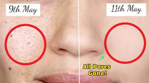 7 remes to get rid of large pores on