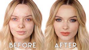 acne coverage soft glam makeup tutorial