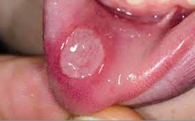 raising awareness of mouth ulcers