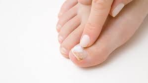toenail fungus weil foot ankle