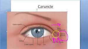 ophthalmology 068 d eye caruncle what