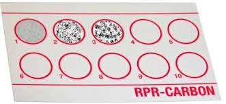 Rapid Plasma Reagin Rpr Test Principle Procedure And