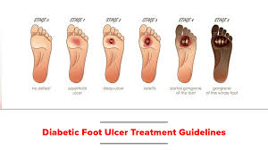 Diabetic Foot Ulcer Treatment Guidelines | BioFlex Pakistan