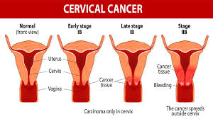 There are two main types of cancer of the cervix — squamous. Cervical Cancer Symptoms Causes Treatment Medicine Prevention Diagnosis Rajasthan Medical Center Tohana