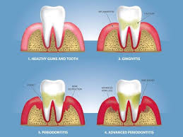 fms dental best flap surgery bone graft