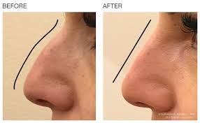 non surgical nose filler contouring