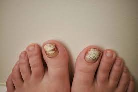 can toenail fungus spread through nail