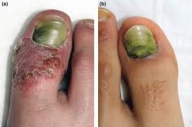 green nail syndrome ociated with
