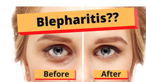 treat blepharitis best home treatment