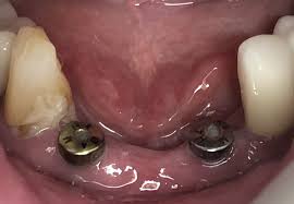 Gum recession is when the margin of gum tissue that surrounds the teeth is pulled away or erodes. Tooth Extraction And Implant Front Tooth Implant Molar Implant