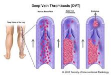 Image result for icd 10 code for chronic dvt unspecified