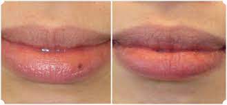 lip mole removal the skiny