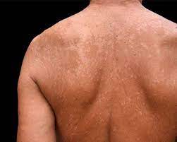 tinea versicolor causes treatment