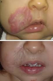 infantile hemangiomas treated by