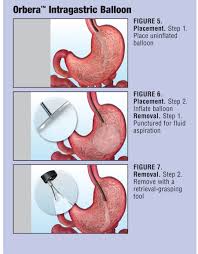 intragastric balloon here