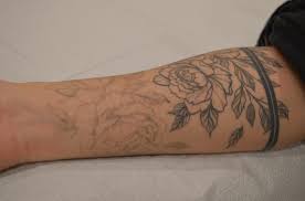 Tattoo removal charges a $200 flat rate per appointment, regardless of how. Is Laser Tattoo Removal Worth It Tattoo Removal Chronic Ink