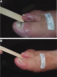 debridement of diabetic foot ulcers