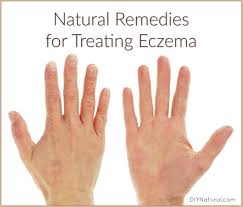 natural remes for eczema both