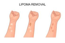 lipomas vs liposarcoma what s the