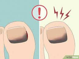 how to treat a black toenail causes