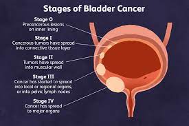 ses of bladder cancer what you need