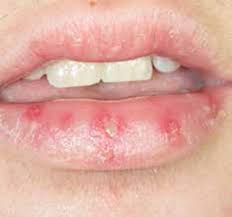 sore or swollen lips part 2 systemic