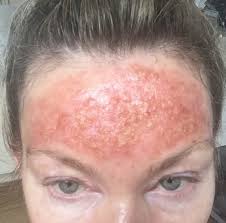 photo dynamic therapy and actinic keratosis