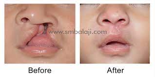 cleft lip surgery in india no 1 best