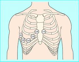 The Ultimate 12 Lead Ecg Placement Guide With Illustrations