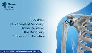 after shoulder replacement surgery