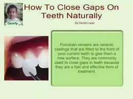 The most common crooked teeth treatment is braces. How To Close Gaps On Teeth Naturally Youtube