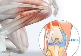 knee plica syndrome causes treatment