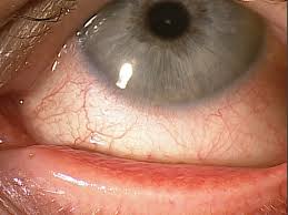 dry eye disease is a secondary condition