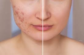 treatment for acne scars